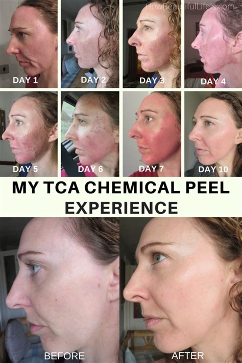 tca peel reviews|tca chemical peel reviews.
